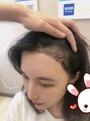 -大麦微针植发丨全国连锁