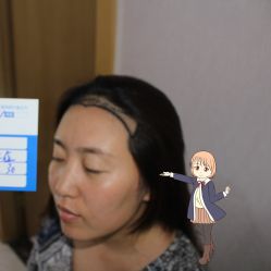 -大麦微针植发丨全国连锁