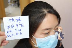 -大麦微针植发丨全国连锁