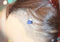 -大麦微针植发全国连锁