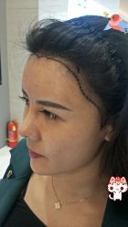 -大麦微针植发丨全国连锁