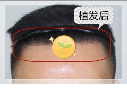 -大麦微针植发全国连锁