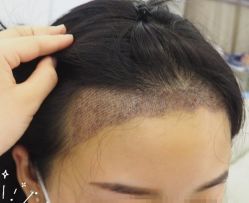 -大麦微针植发丨全国连锁