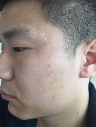 -爱莎扁平疣·汗管瘤·斑痣中心