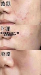 -痘庄科学祛痘国际连锁