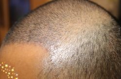 -大麦微针植发丨全国连锁