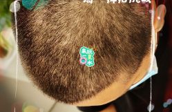 -大麦微针植发全国连锁