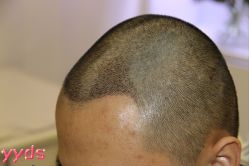 -大麦微针植发丨全国连锁