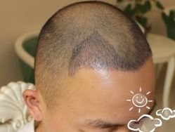 -大麦微针植发丨全国连锁