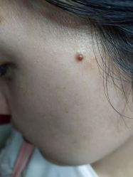 -北京美痣堂古方祛痣斑疣瘊
