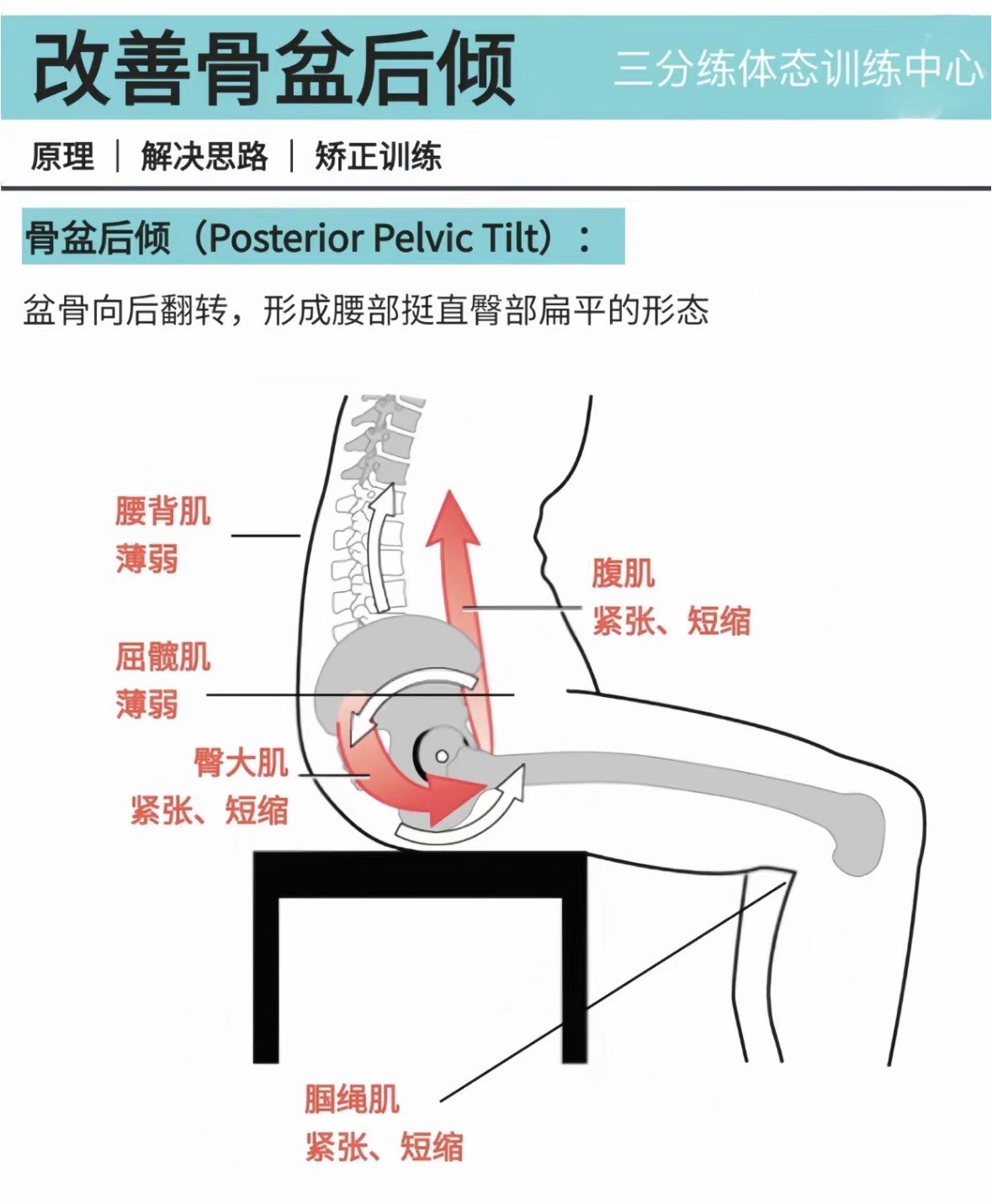 骨盆后倾的危害图片