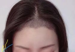 -大麦微针植发丨全国连锁