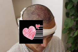 -大麦微针植发丨全国连锁