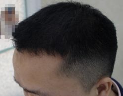 -大麦微针植发全国连锁