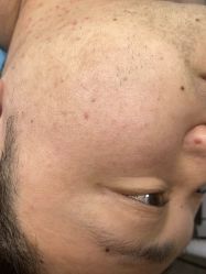 -爱莎扁平疣·汗管瘤·斑痣中心