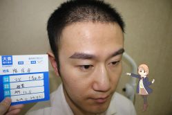 -大麦微针植发丨全国连锁