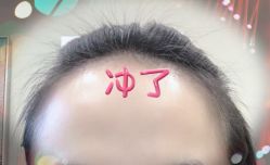 -大麦微针植发全国连锁