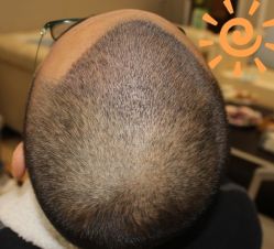 -大麦微针植发丨全国连锁