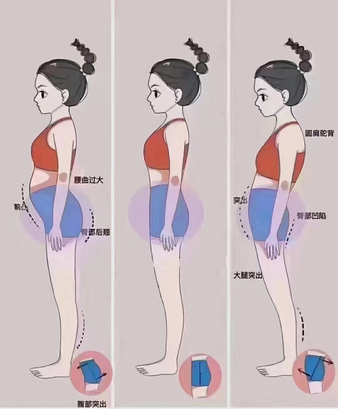 骨盆前倾,后倾怎么办