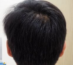 -大麦微针植发丨全国连锁