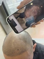 -碧莲盛·不剃发植发