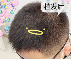 -大麦微针植发全国连锁