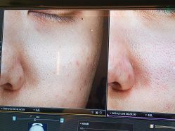-苑苑vbeauty科技美容SPA
