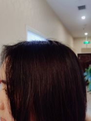 -碧莲盛·不剃发植发