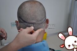 点击看大图 -大麦微针植发丨全国连锁