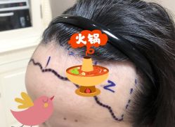 -大麦微针植发全国连锁