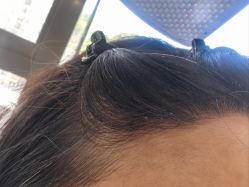 -碧莲盛·不剃发植发