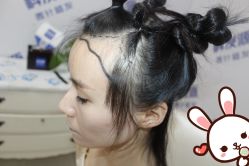 -大麦微针植发丨全国连锁