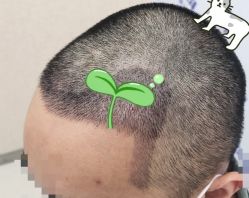 -大麦微针植发全国连锁