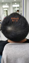 点击看大图 体验后-大麦微针植发全国连锁