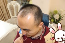 点击看大图 -大麦微针植发丨全国连锁