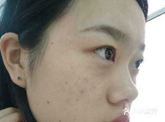 发肿，在手术后的一个小时就消失了，就不会痛和肿了
