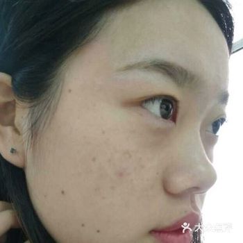 发肿,在手术后的一个小时就消失了,就不会痛和肿了