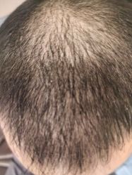 -碧莲盛·不剃发植发