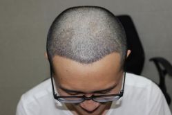 -大麦微针植发丨全国连锁