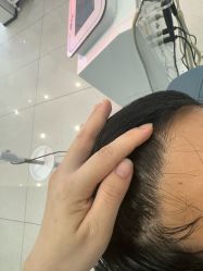 -大麦微针植发丨全国连锁