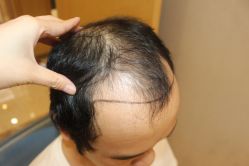 -大麦微针植发丨全国连锁