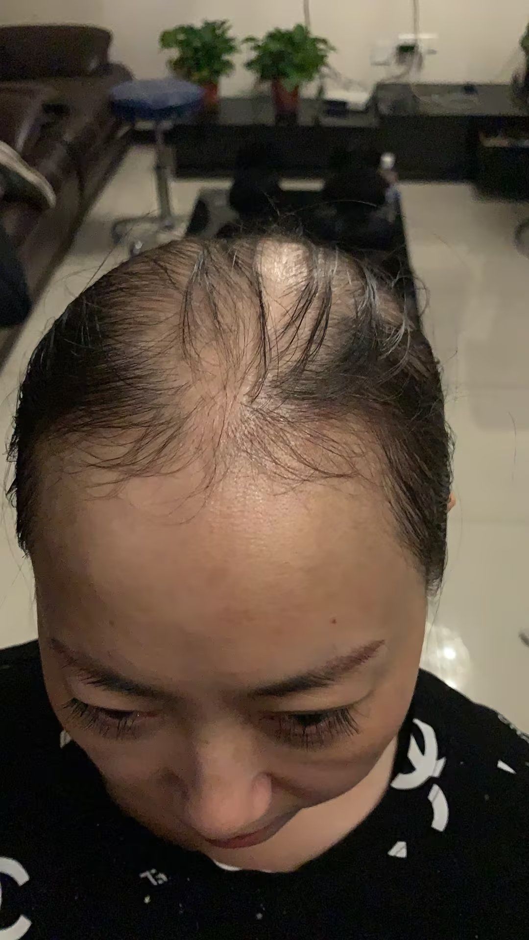 女士假发.摆脱大秃头