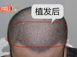 -大麦微针植发全国连锁