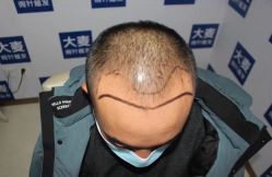 -大麦微针植发丨全国连锁