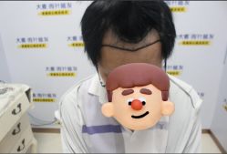 -大麦微针植发丨全国连锁