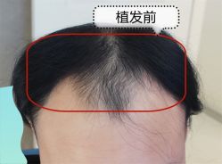 -大麦微针植发全国连锁