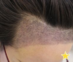 -大麦微针植发丨全国连锁