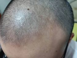 -大麦微针植发丨全国连锁