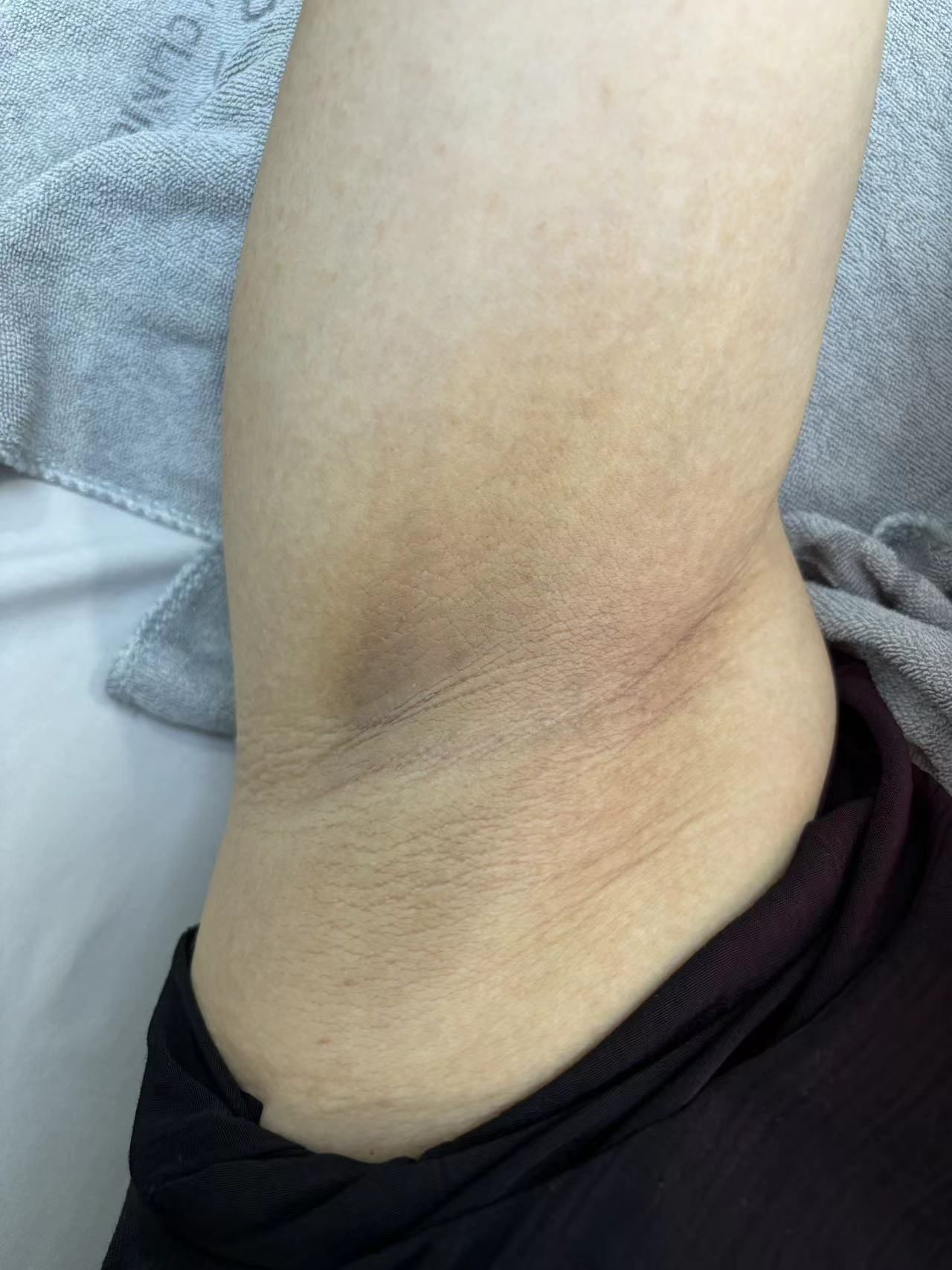 腋下色素问题的尴尬,在野特骆医生推荐下