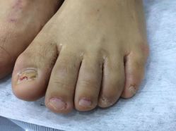 -德哥灰指甲脚气甲沟炎跖疣护理